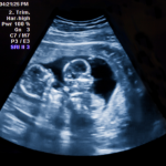 A Dra. Thaline Neves orienta como a medicina fetal assegura gestação mais tranquila em casos de gêmeos.