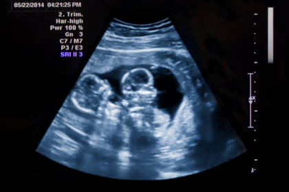 A Dra. Thaline Neves orienta como a medicina fetal assegura gestação mais tranquila em casos de gêmeos.