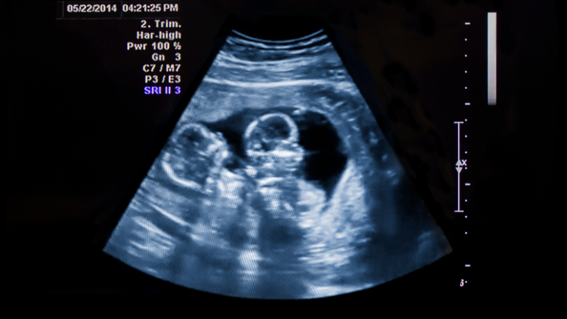 A Dra. Thaline Neves orienta como a medicina fetal assegura gestação mais tranquila em casos de gêmeos.